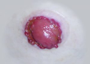 Colostomy multiple granulomas