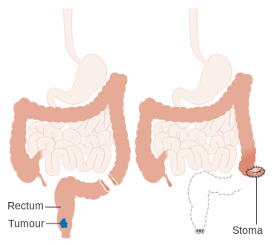 Why you might you need a convex stoma bag