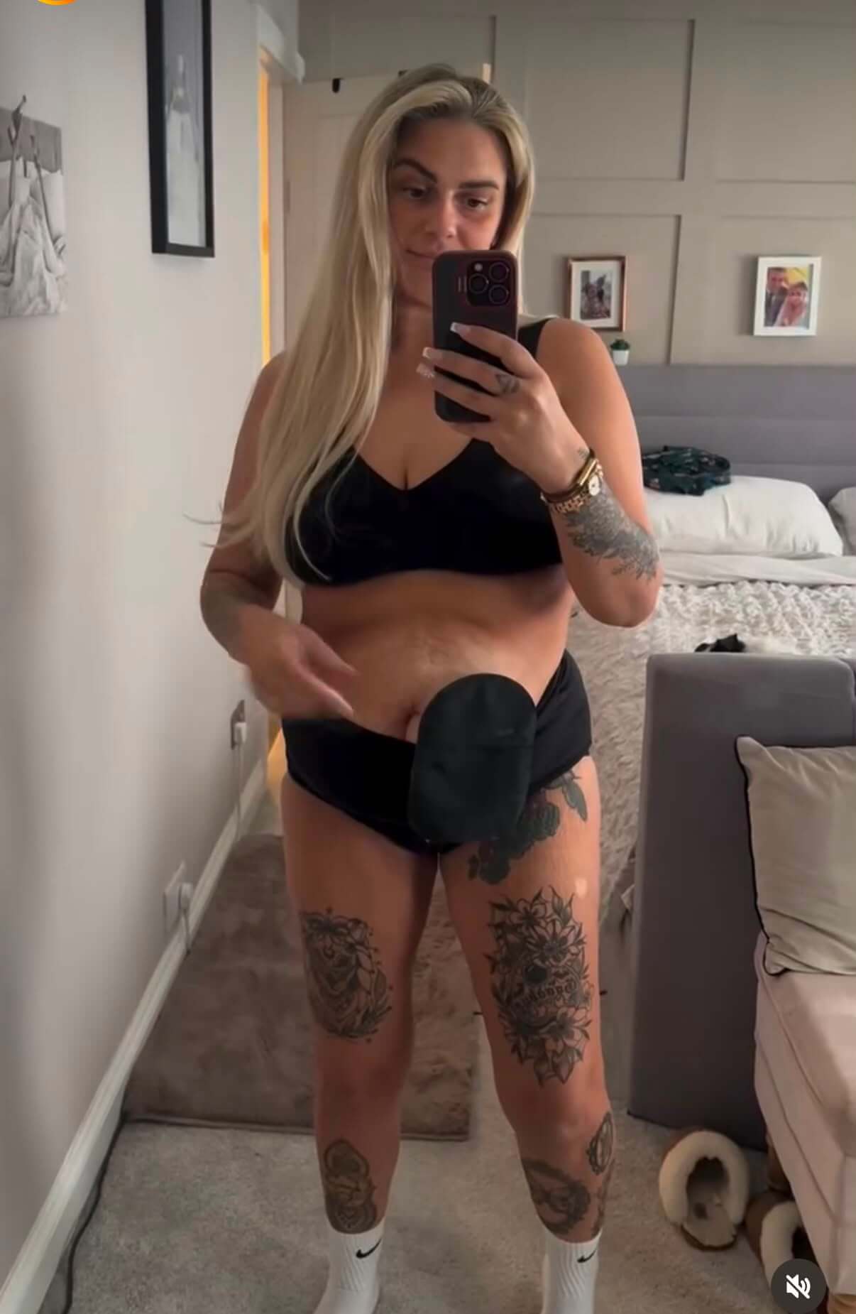 Living with a stoma